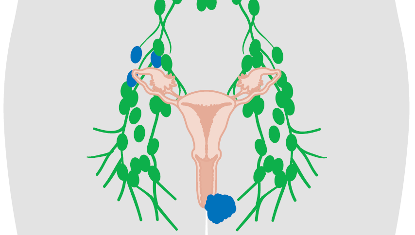 Inguinofemoral Lymph Node Dissection Full 